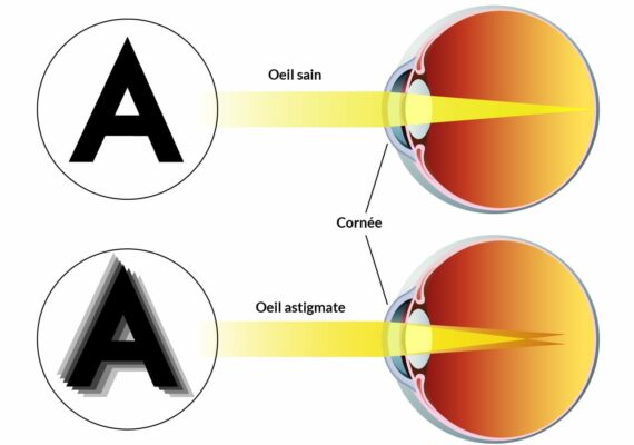 Astigmatisme