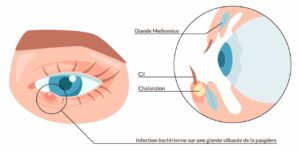 Chalazion