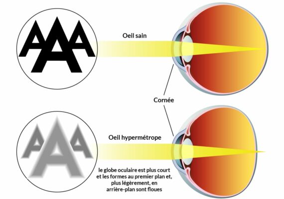 Hypermétropie