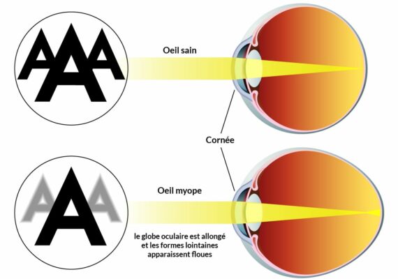 Myopie